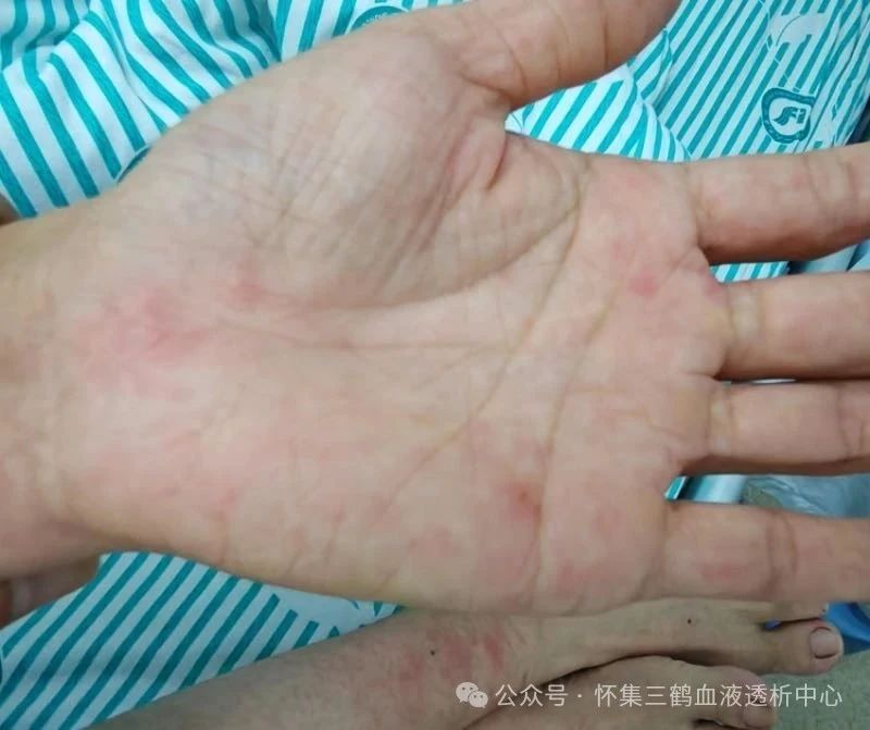 基孔肯雅热的临床特征与治疗原则