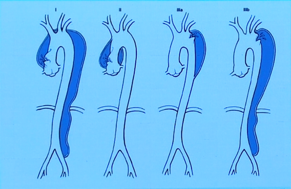 早期识别、及时处理，凶险的主动脉夹层你了解多少？